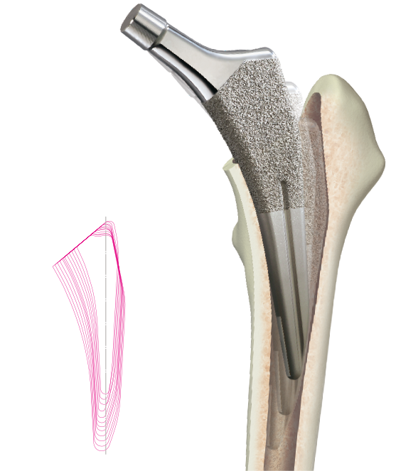Tapered-Wedge Stem Design