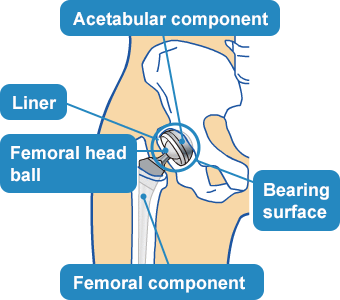 Mechanics of Artificial Hip Joints