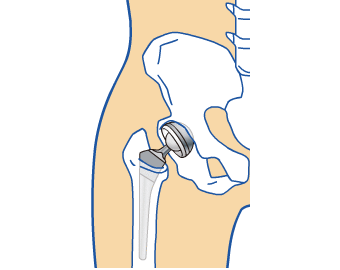 Problems with Artificial Hip Joints