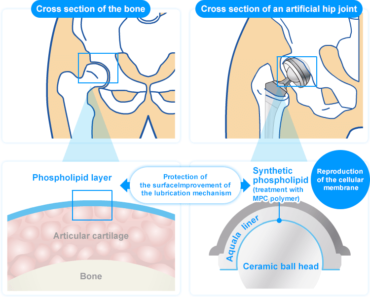 Cross section of the bone,Cross section of an artificial hip joint